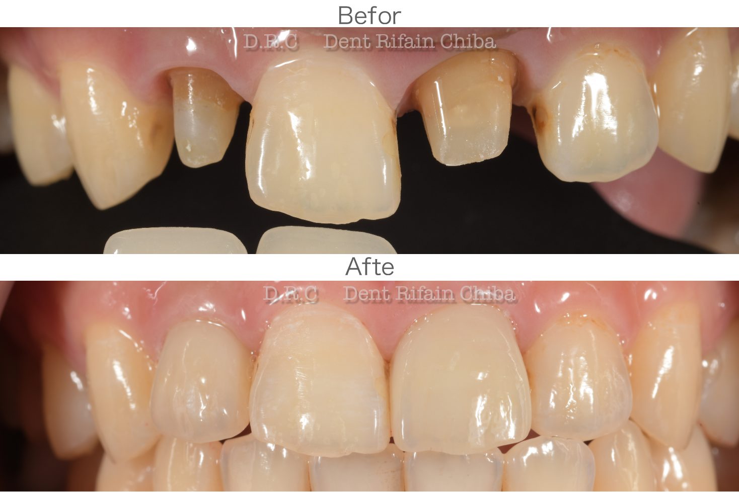 フルカバーレイヤリングPFZ | D.R.C歯科技工所